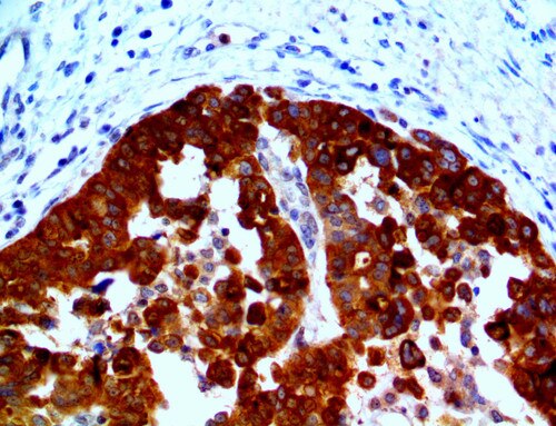 IHC of HE4 on a FFPE Ovarian Cancer Tissue